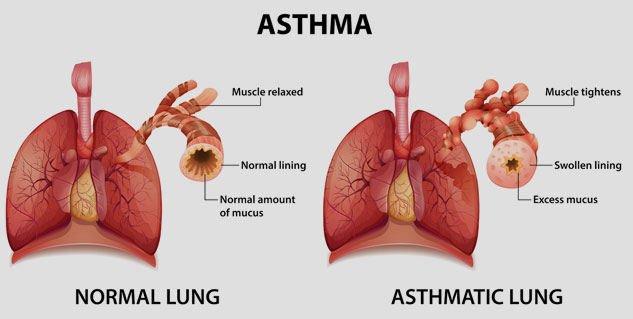 asthma-care-tips-onlymyhealth