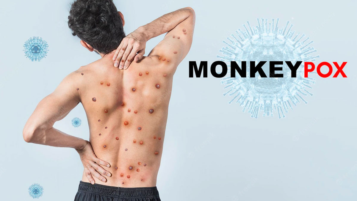 monkeypox