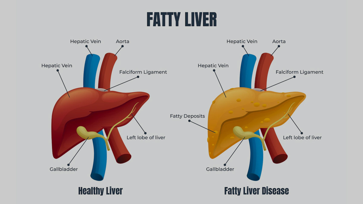 Vitamin for Non-Alcoholic Fatty Liver Disease