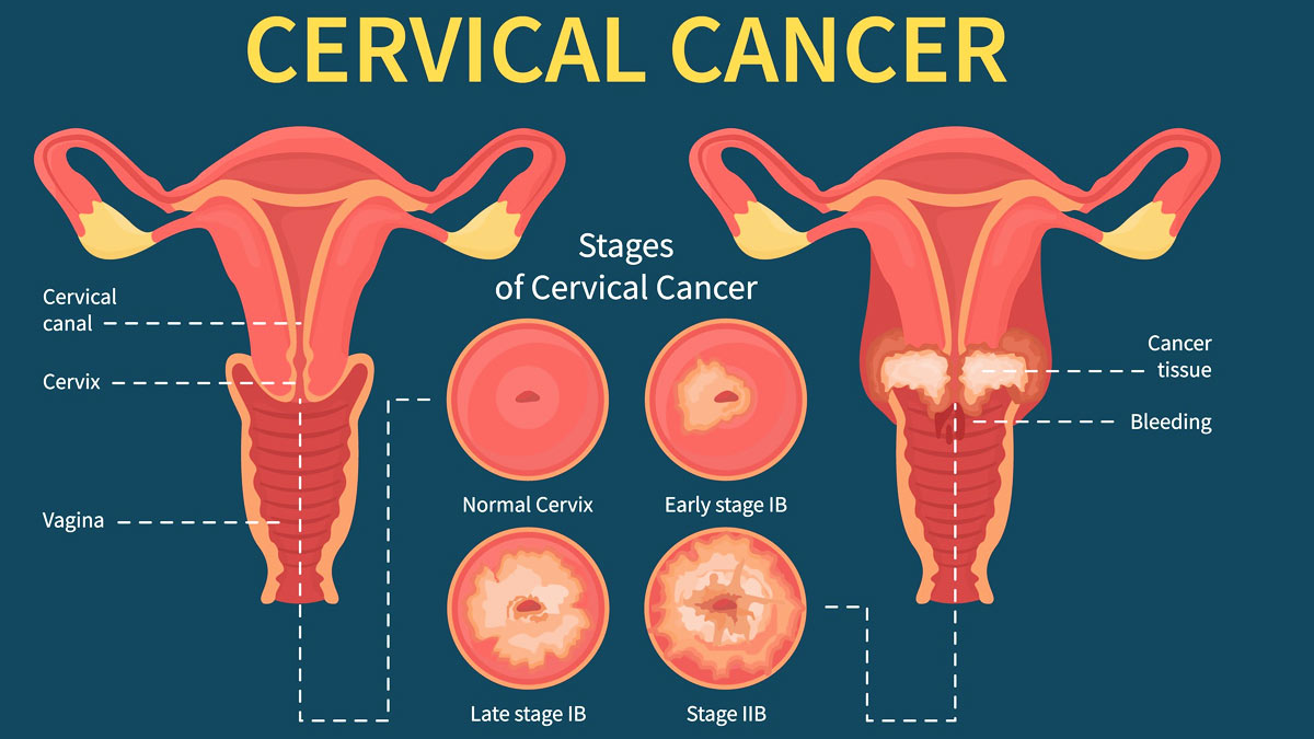Types of Gynaecological Cancer