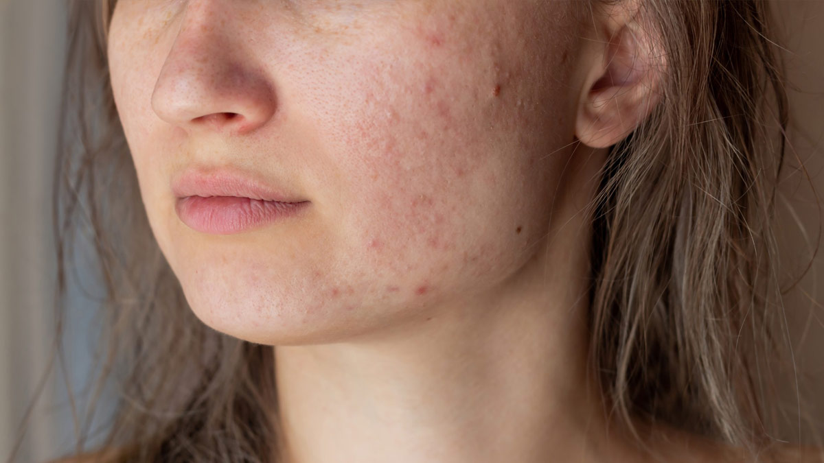 What Is Adult Acne 