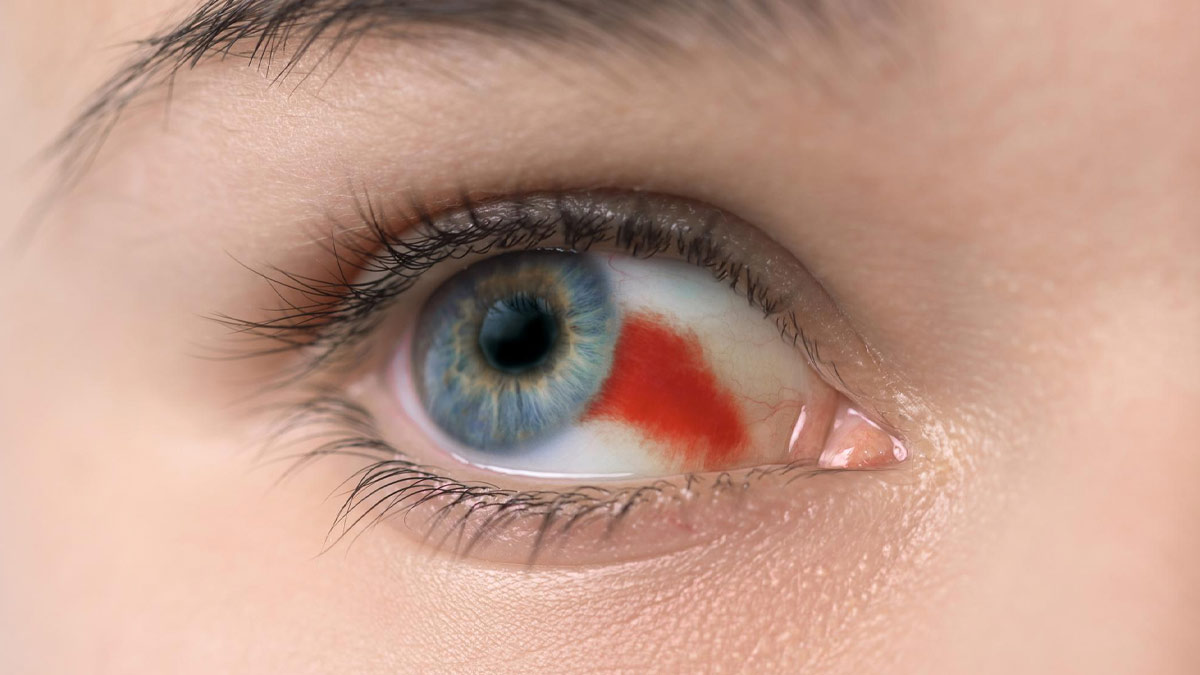 Types Causes Symptoms And Treatment Of Eye Bleeding