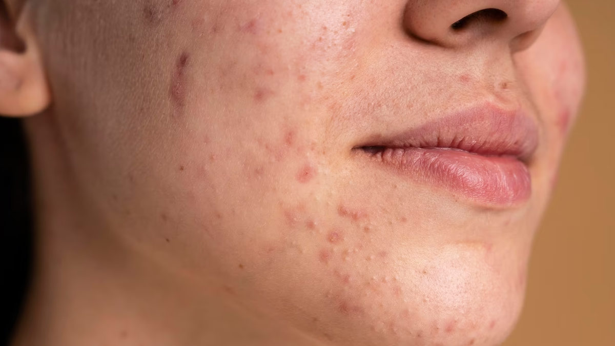 Difference Between Hormonal Acne and Adult Acne
