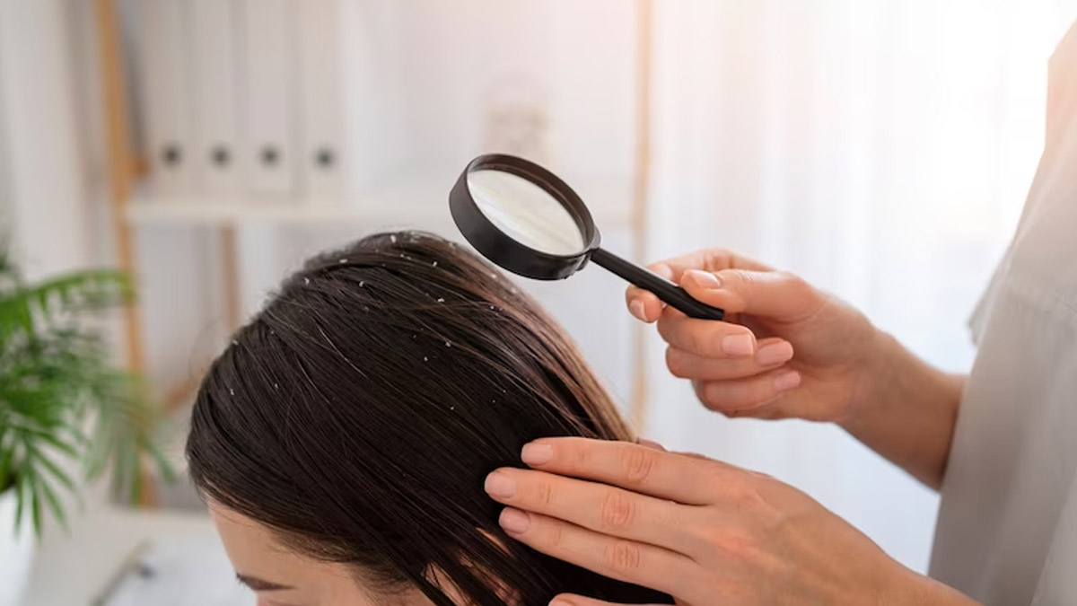 scalp-eczema