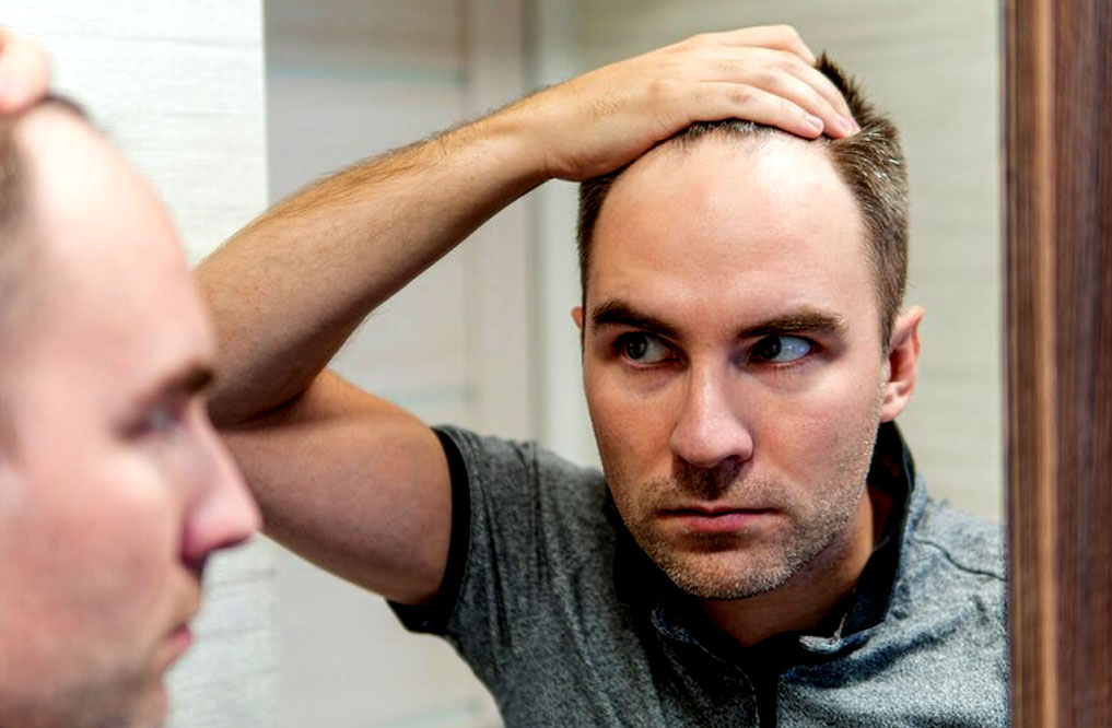 What Causes Teenage Balding