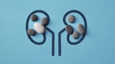 kidney stones with beer