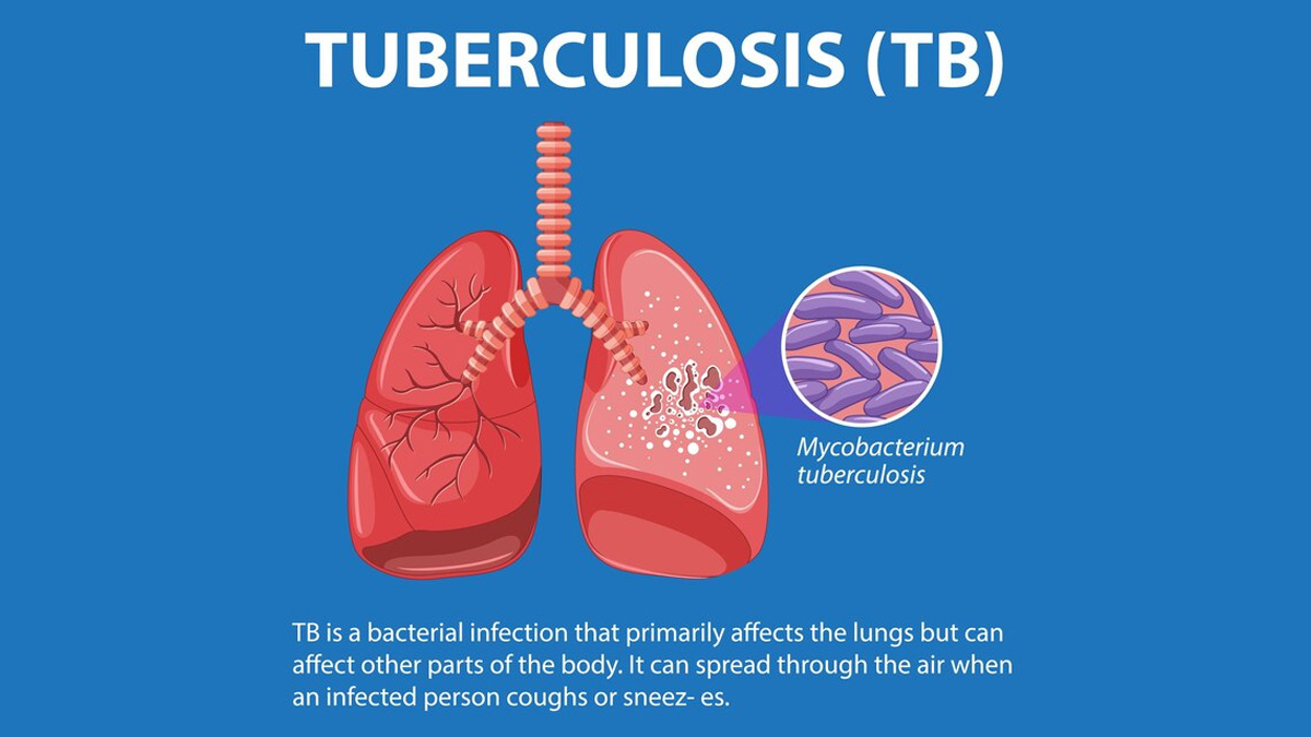 Lancet Study Reveals Over 80% of TB Patients Do Not Show Persistent Cough, Other Warning Signs of TB