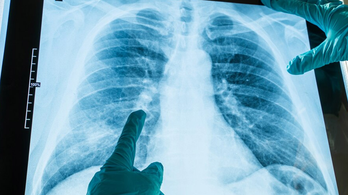 The Most Common Types of Respiratory Diseases