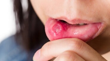 A mouth ulcer on the inner lip